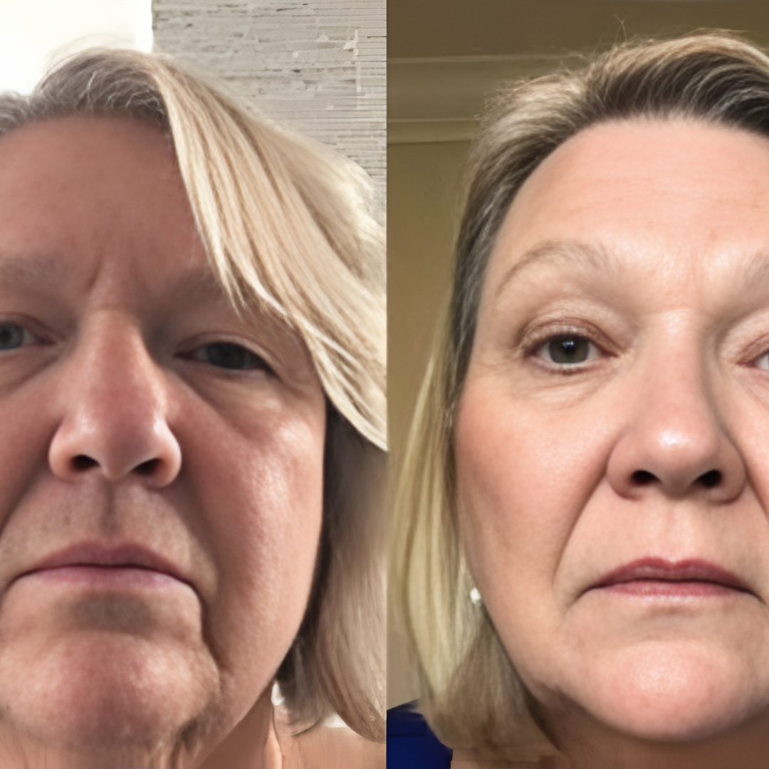 Regenskin At Home Microneedling Kit