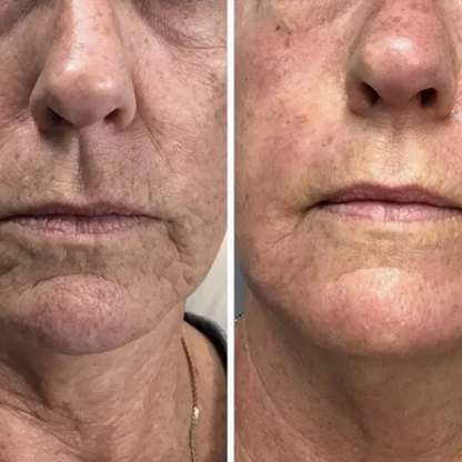 Regenskin At Home Microneedling Kit