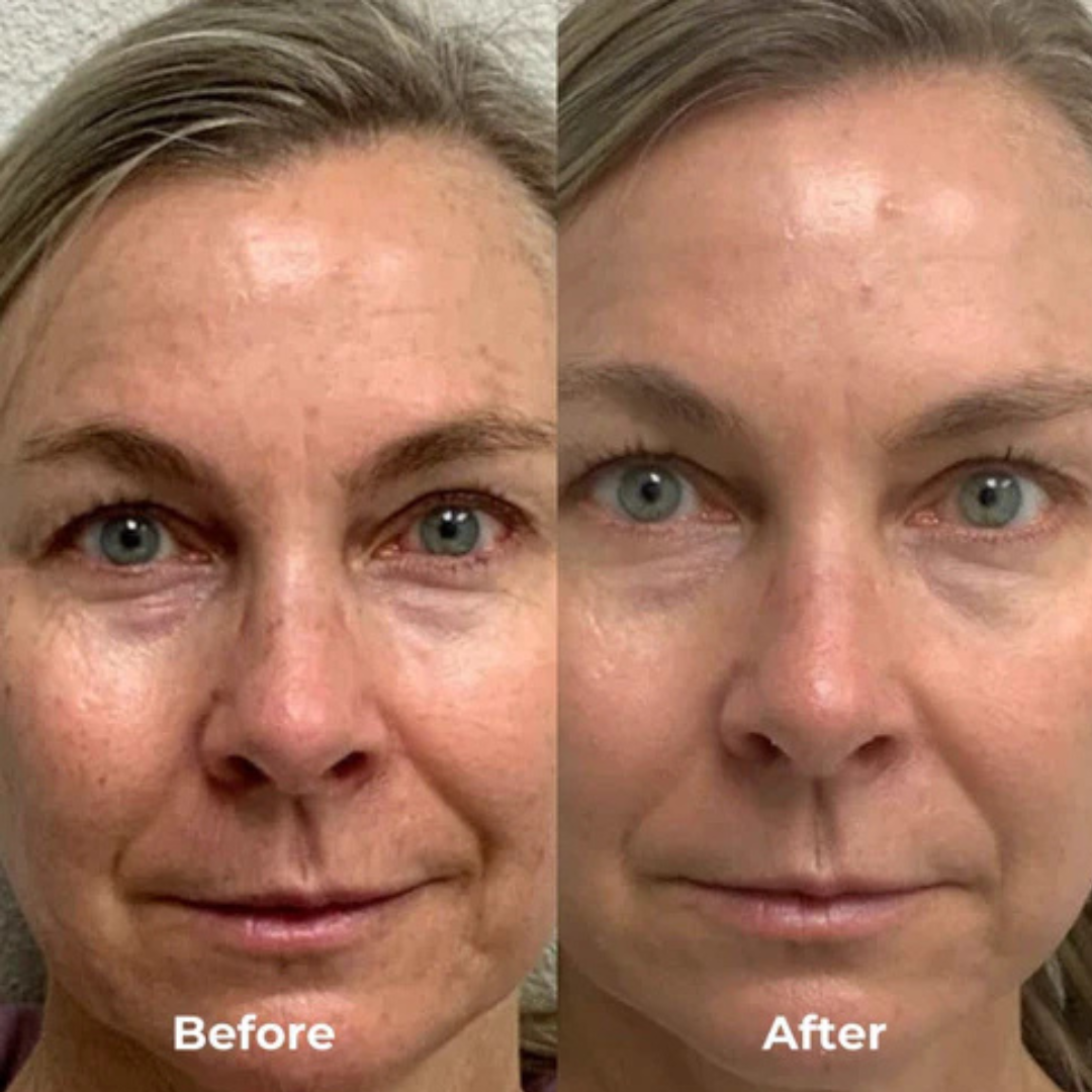 Regenskin At Home Microneedling Kit