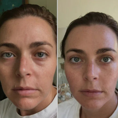 Regenskin At Home Microneedling Kit