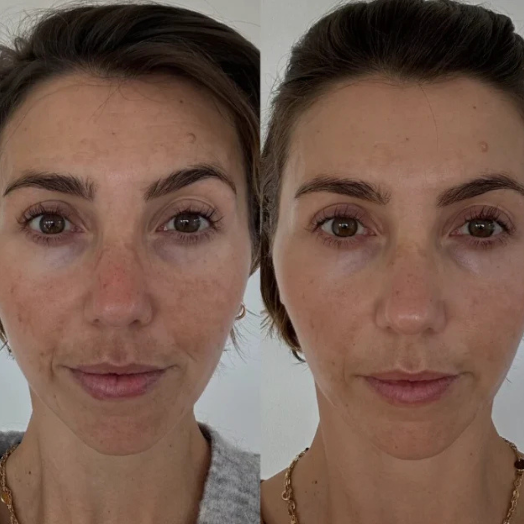 Regenskin At Home Microneedling Kit